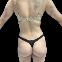 Brazilian Butt Lift Before & After Patient #2988