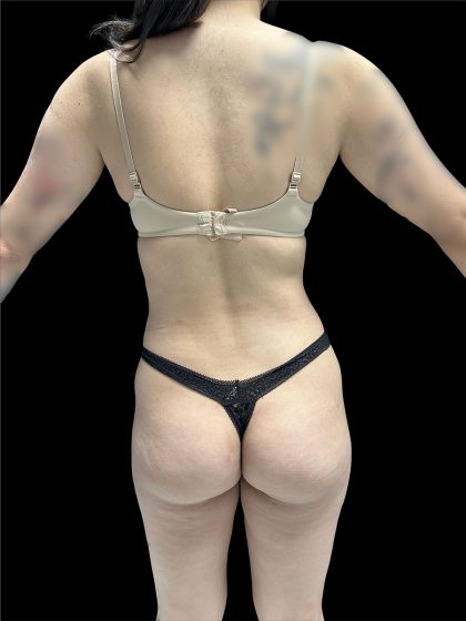 Brazilian Butt Lift Before & After Patient #2988
