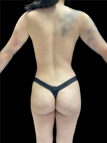 Brazilian Butt Lift Before & After Patient #2988