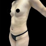 Brazilian Butt Lift Before & After Patient #2988