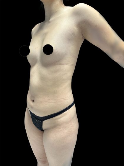 Brazilian Butt Lift Before & After Patient #2988