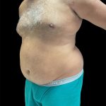 Daddy Do Over Before & After Patient #2991