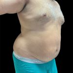 Daddy Do Over Before & After Patient #2991