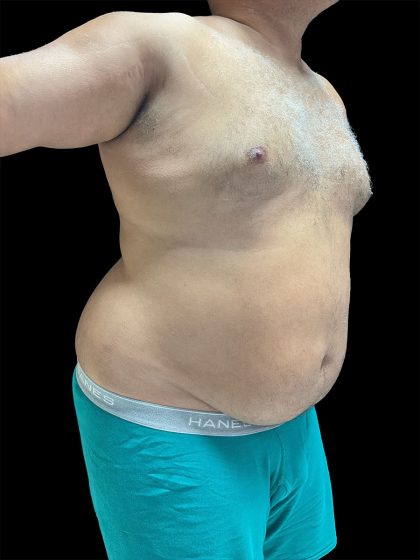 Daddy Do Over Before & After Patient #2991