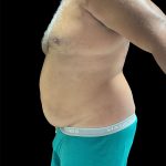 Daddy Do Over Before & After Patient #2991