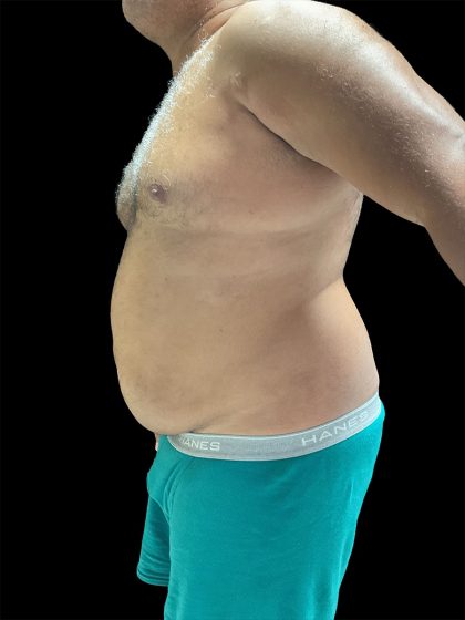 Daddy Do Over Before & After Patient #2991