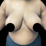 Breast Reduction Before & After Patient #3066