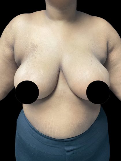 Breast Reduction Before & After Patient #3066