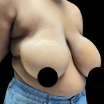 Breast Reduction Before & After Patient #3066