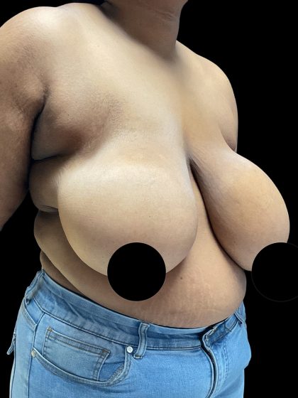 Breast Reduction Before & After Patient #3066