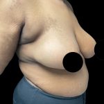 Breast Reduction Before & After Patient #3066