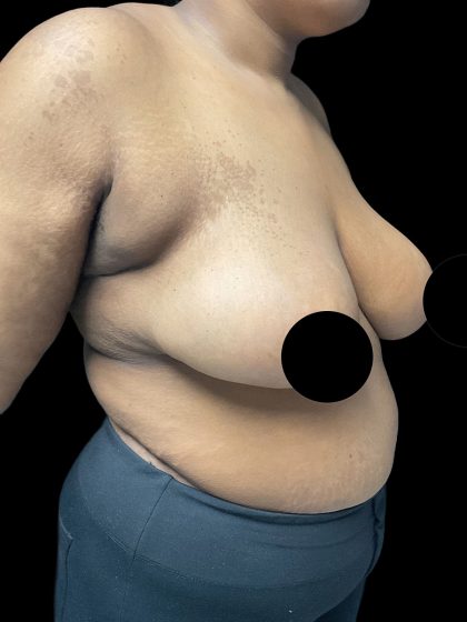 Breast Reduction Before & After Patient #3066