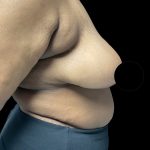 Breast Reduction Before & After Patient #3066
