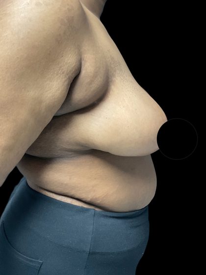 Breast Reduction Before & After Patient #3066