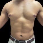 VASER Liposuction Before & After Patient #3073