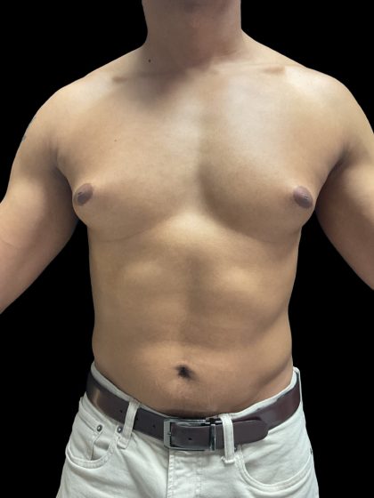 VASER Liposuction Before & After Patient #3073