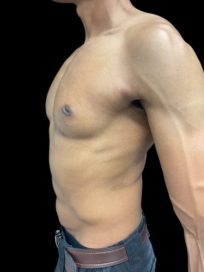 VASER Liposuction Before & After Patient #3073