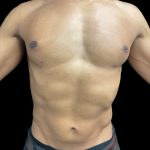 VASER Liposuction Before & After Patient #3073