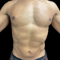 VASER Liposuction Before & After Patient #3073