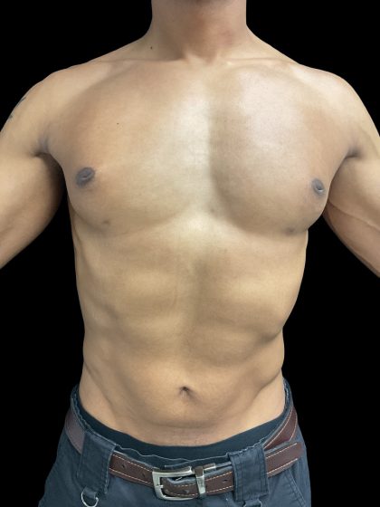 VASER Liposuction Before & After Patient #3073