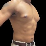 VASER Liposuction Before & After Patient #3073
