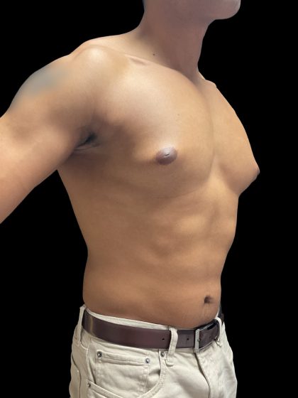 VASER Liposuction Before & After Patient #3073