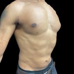 VASER Liposuction Before & After Patient #3073