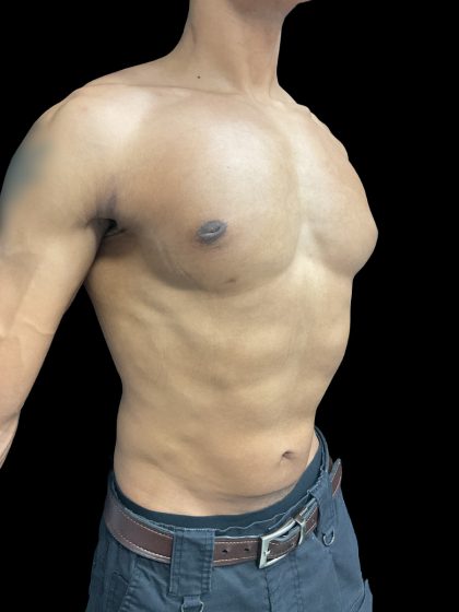 VASER Liposuction Before & After Patient #3073