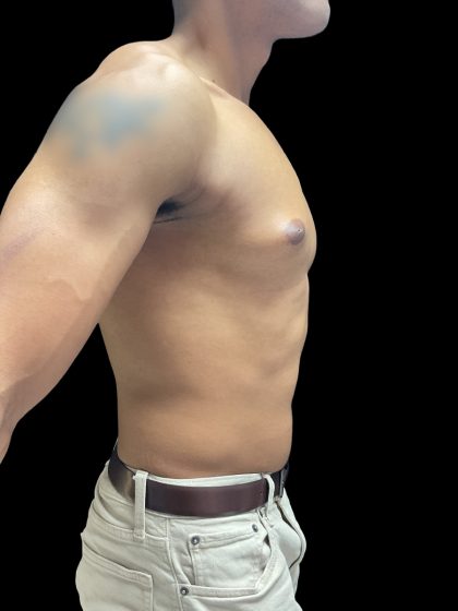 VASER Liposuction Before & After Patient #3073
