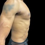 VASER Liposuction Before & After Patient #3073