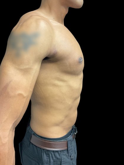 VASER Liposuction Before & After Patient #3073