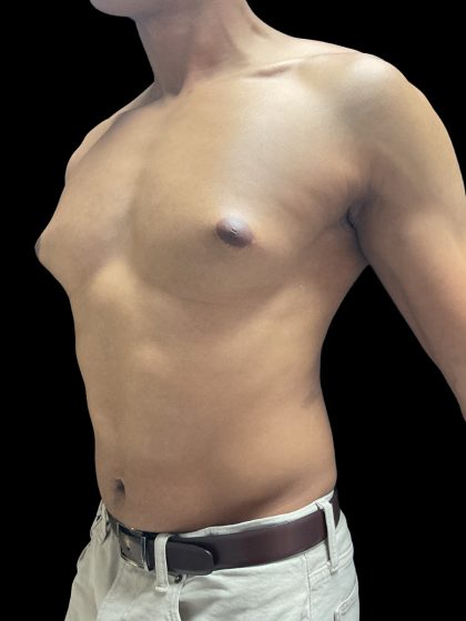 VASER Liposuction Before & After Patient #3073