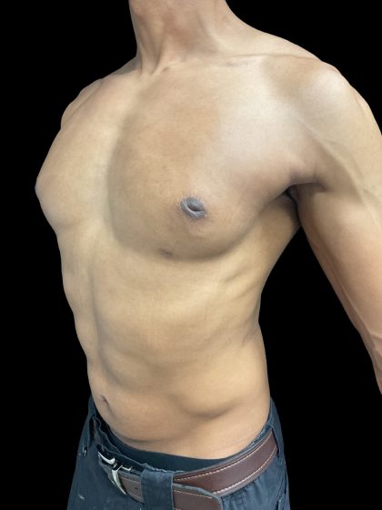VASER Liposuction Before & After Patient #3073