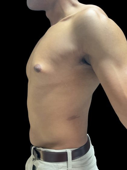 VASER Liposuction Before & After Patient #3073