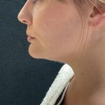 Neck Liposuction Before & After Patient #3104