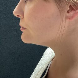 Neck Liposuction Before & After Patient #3104