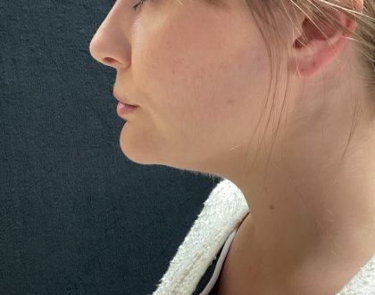 Neck Liposuction Before & After Patient #3104