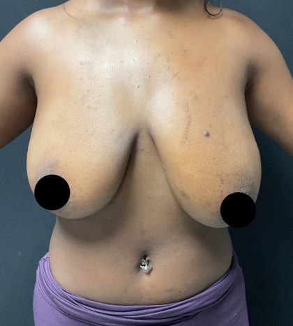 Breast Reduction Before & After Patient #3107