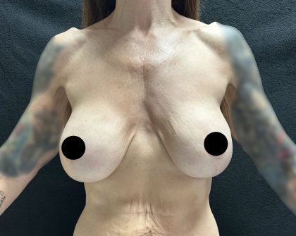 Breast Augmentation Before & After Patient #3112