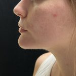 Neck Liposuction Before & After Patient #3104