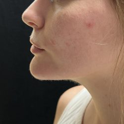 Neck Liposuction Before & After Patient #3104