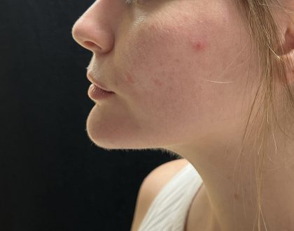 Neck Liposuction Before & After Patient #3104