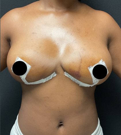 Breast Reduction Before & After Patient #3107