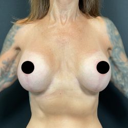 Breast Augmentation Before & After Patient #3112