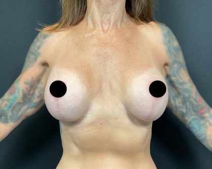 Breast Augmentation Before & After Patient #3112