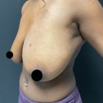 Breast Reduction Before & After Patient #3107