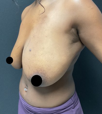 Breast Reduction Before & After Patient #3107