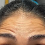 Neurotoxins Before & After Patient #3099
