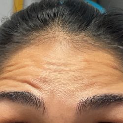Neurotoxins Before & After Patient #3099