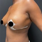 Breast Reduction Before & After Patient #3107